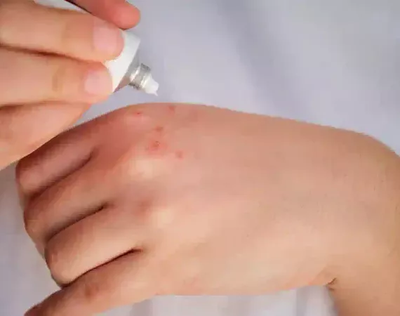Hand mit Hautläsionen, die Person trägt eine weiße Salbe aus einer Tube auf.