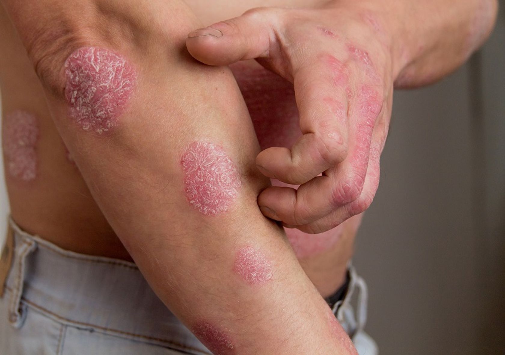 Psoriasis und atopische Dermatitis an Hand und Arm