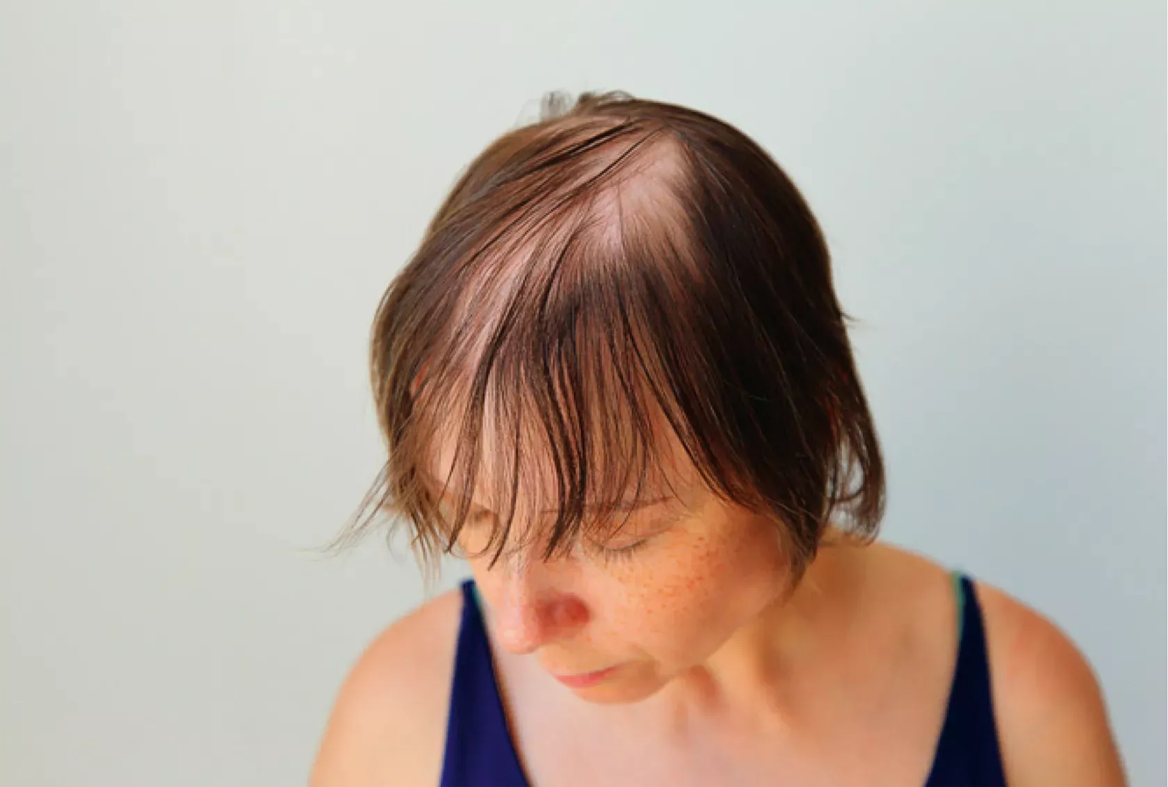 Therapie von Kreisrundem Haarausfall